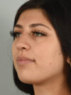 Rhinoplasty case #11715