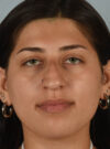 Rhinoplasty case #11715
