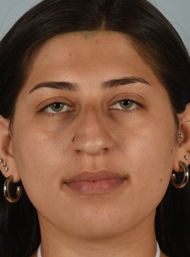 Rhinoplasty case #11715