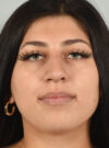Rhinoplasty case #11715