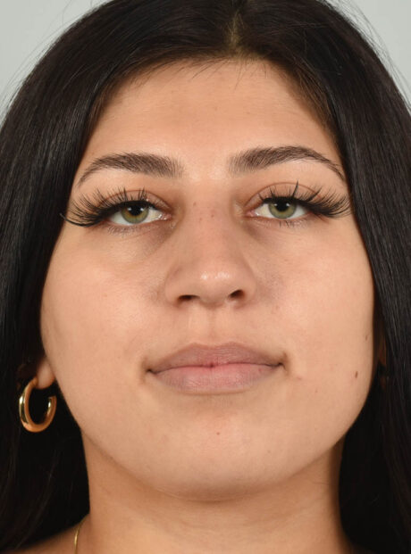 Rhinoplasty case #11715