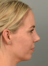 Chin Augmentation case #11717