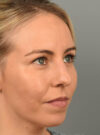 Chin Augmentation case #11717