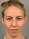 Chin Augmentation case #11717