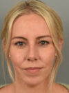 Chin Augmentation case #11717