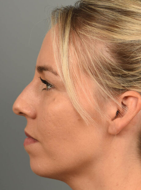 Chin Augmentation case #11717