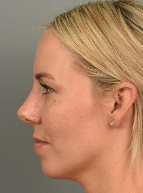 Chin Augmentation case #11717