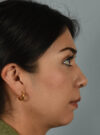 Rhinoplasty case #11706