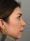Rhinoplasty case #11706