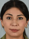 Rhinoplasty case #11706