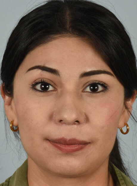 Rhinoplasty case #11706