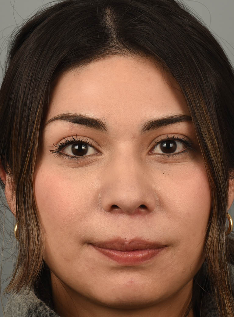 Rhinoplasty case #11706