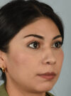 Rhinoplasty case #11706