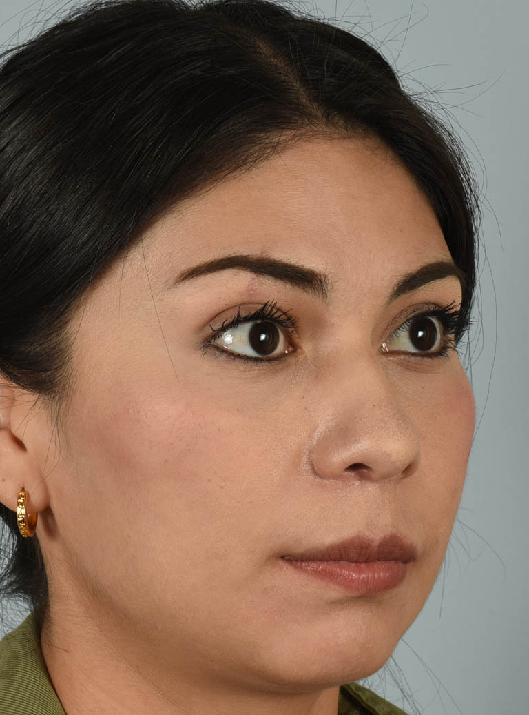 Rhinoplasty case #11706