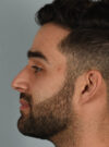 Rhinoplasty case #11704