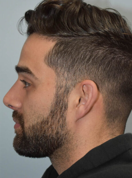 Rhinoplasty case #11704