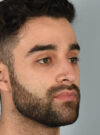 Rhinoplasty case #11704