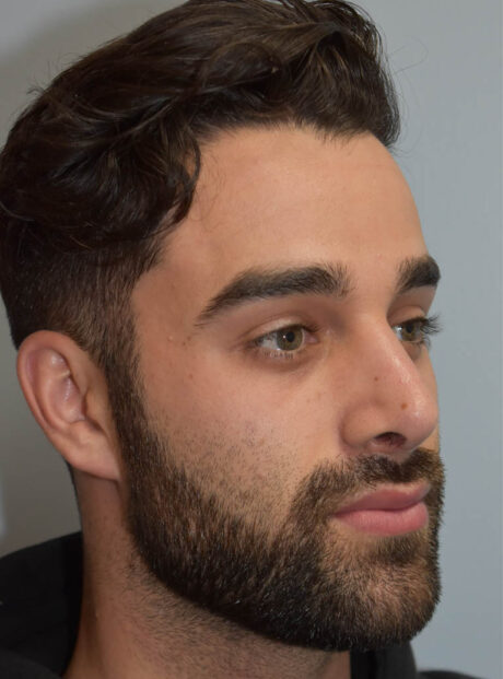 Rhinoplasty case #11704