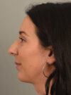 Rhinoplasty case #11718