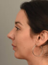 Rhinoplasty case #11718