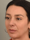 Rhinoplasty case #11718