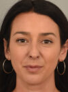 Rhinoplasty case #11718