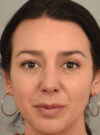Rhinoplasty case #11718