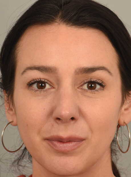 Rhinoplasty case #11718