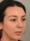 Rhinoplasty case #11718