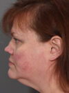 Rhinoplasty case #11700