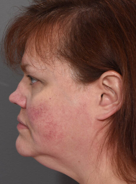 Rhinoplasty case #11700