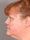 Rhinoplasty case #11700