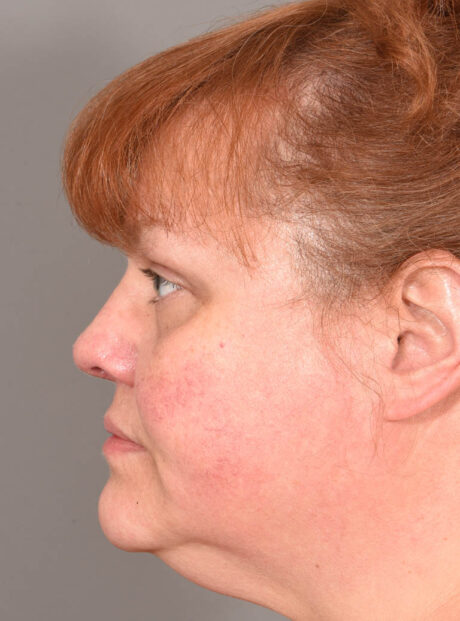 Rhinoplasty case #11700