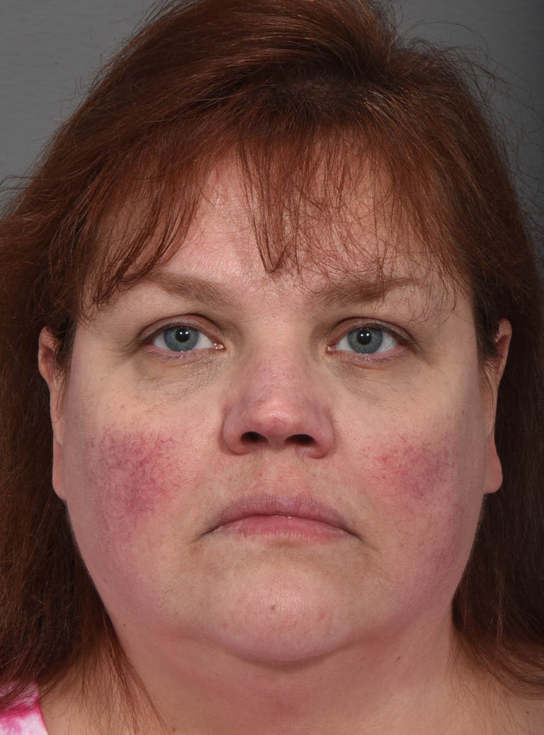 Rhinoplasty case #11700