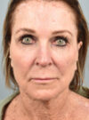 Facelift case #11812