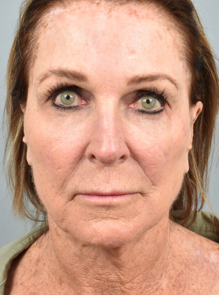 Facelift case #11812