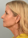 Facelift case #11468