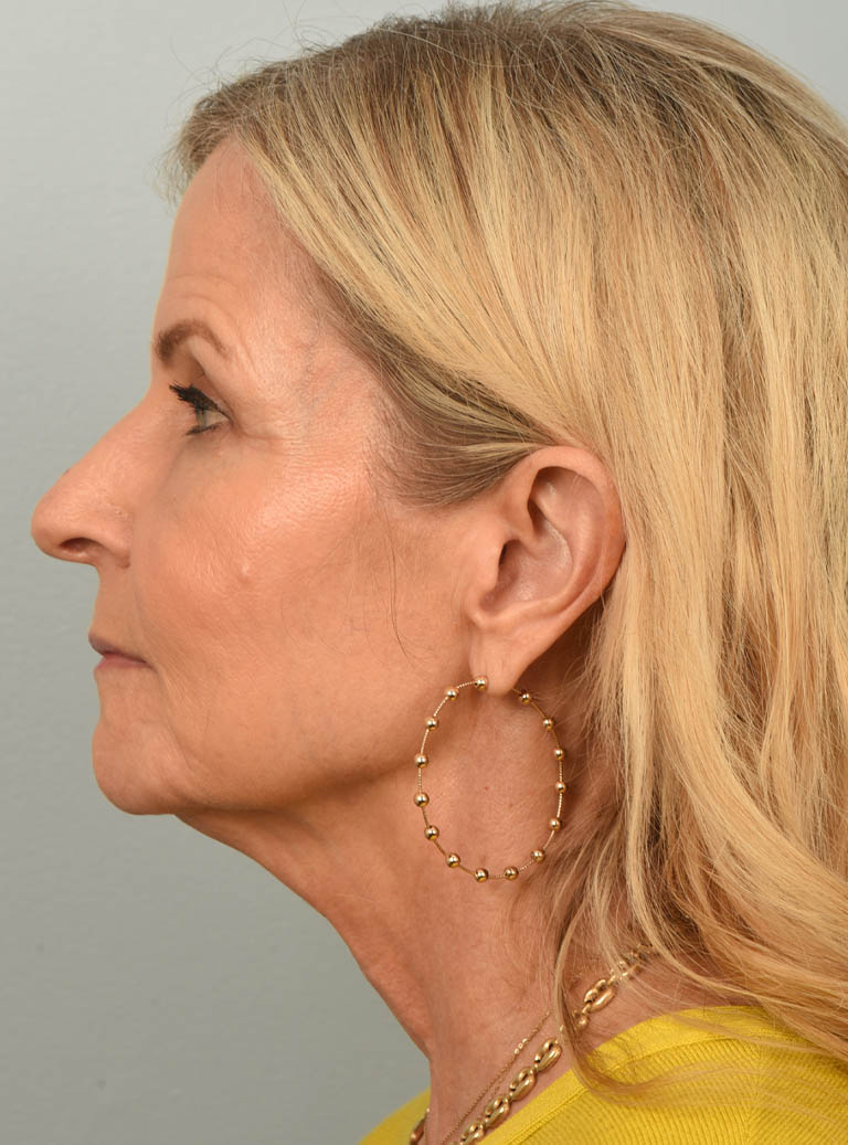 Facelift case #11468
