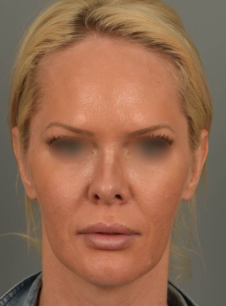 Lip Lift case #11737