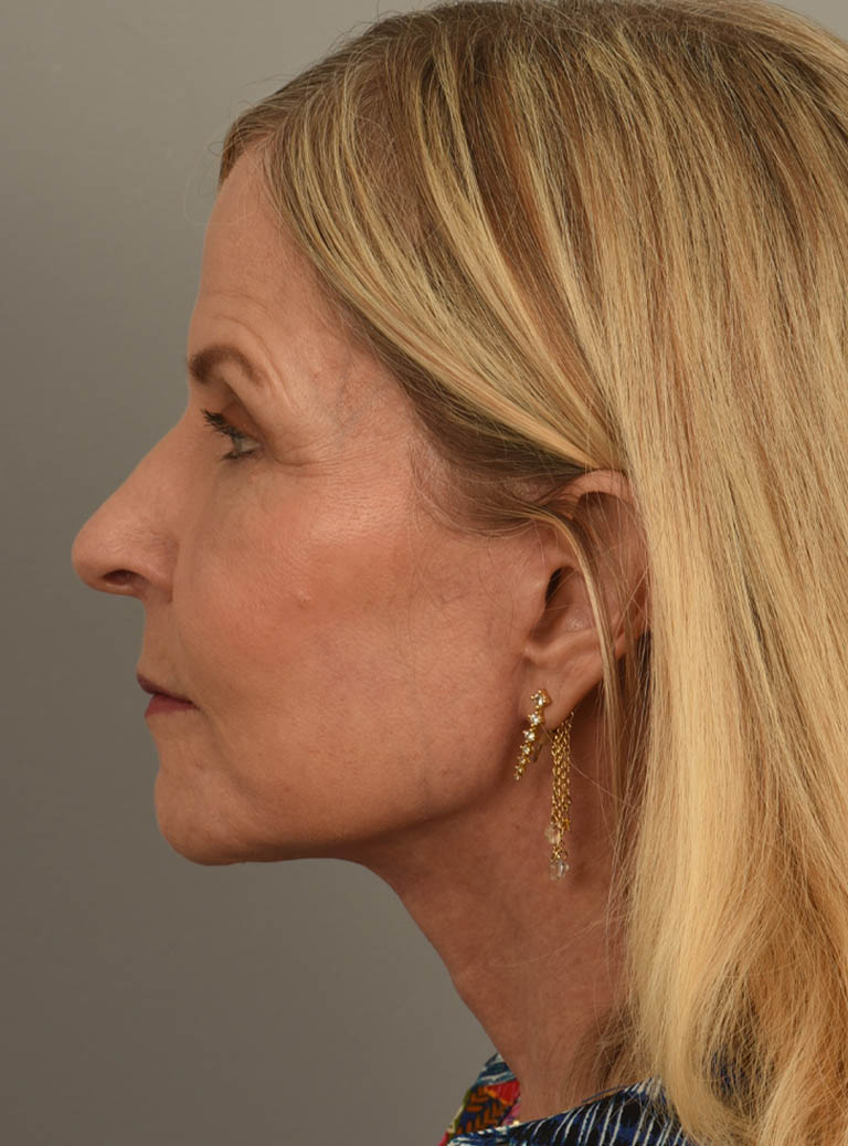 Facelift case #11468