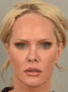 Lip Lift case #11737