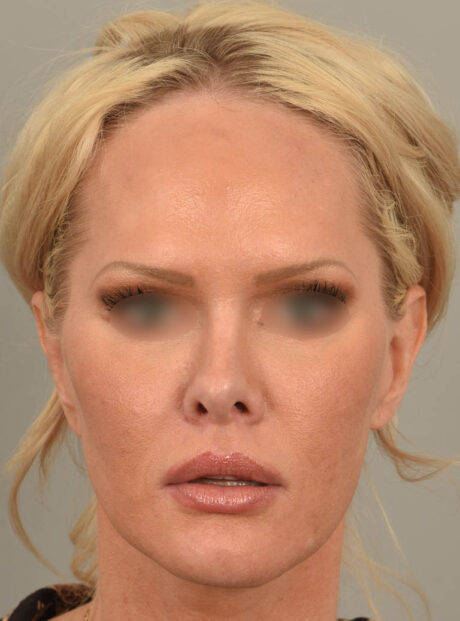 Lip Lift case #11737