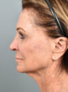 Facelift case #11812