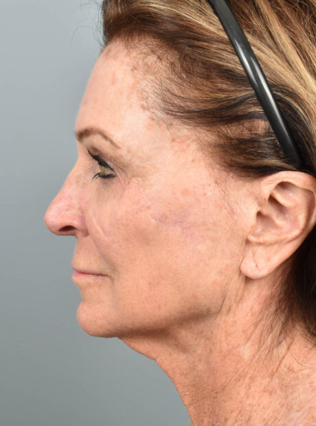 Facelift case #11812