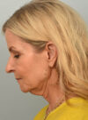 Facelift case #11468