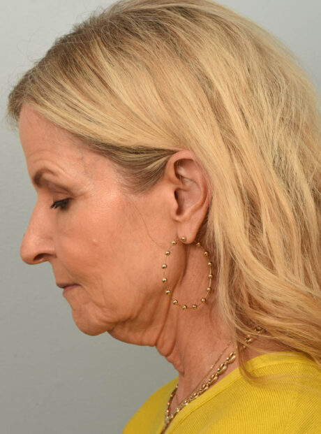 Facelift case #11468