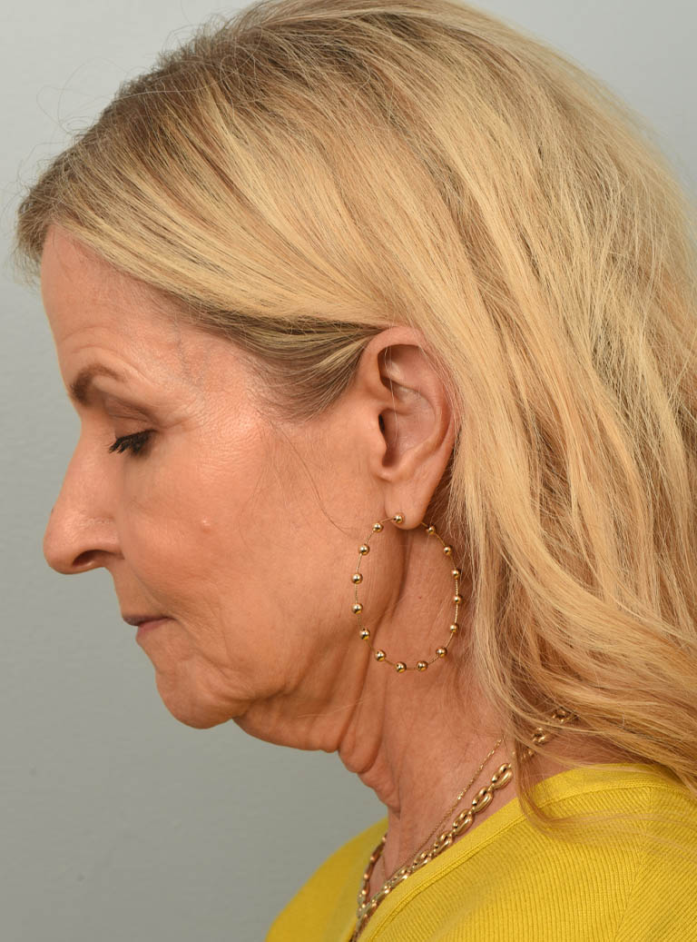 Facelift case #11468