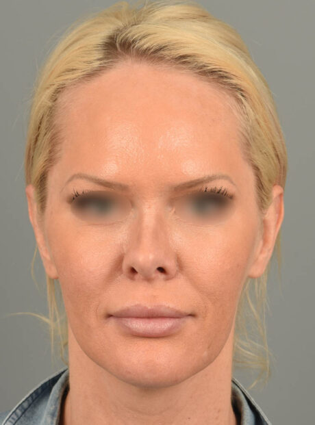 Lip Lift case #11737