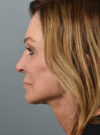 Facelift case #11812