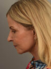 Facelift case #11468